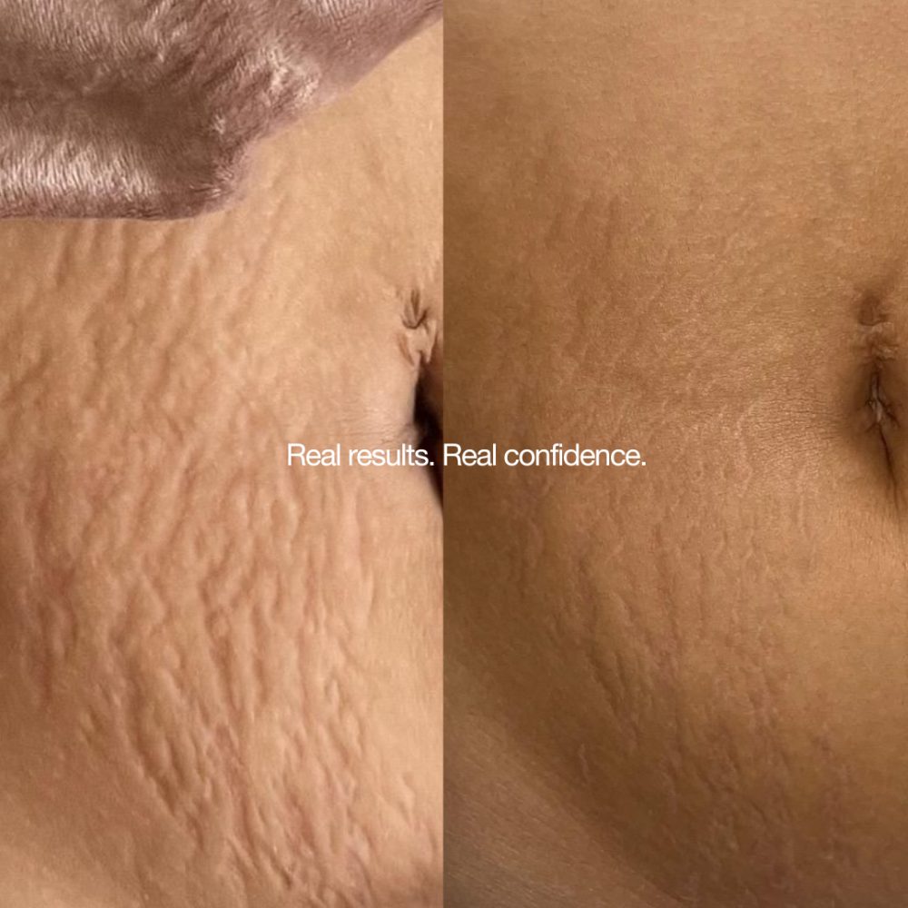 Striā Lab Programme before and after, abdomen