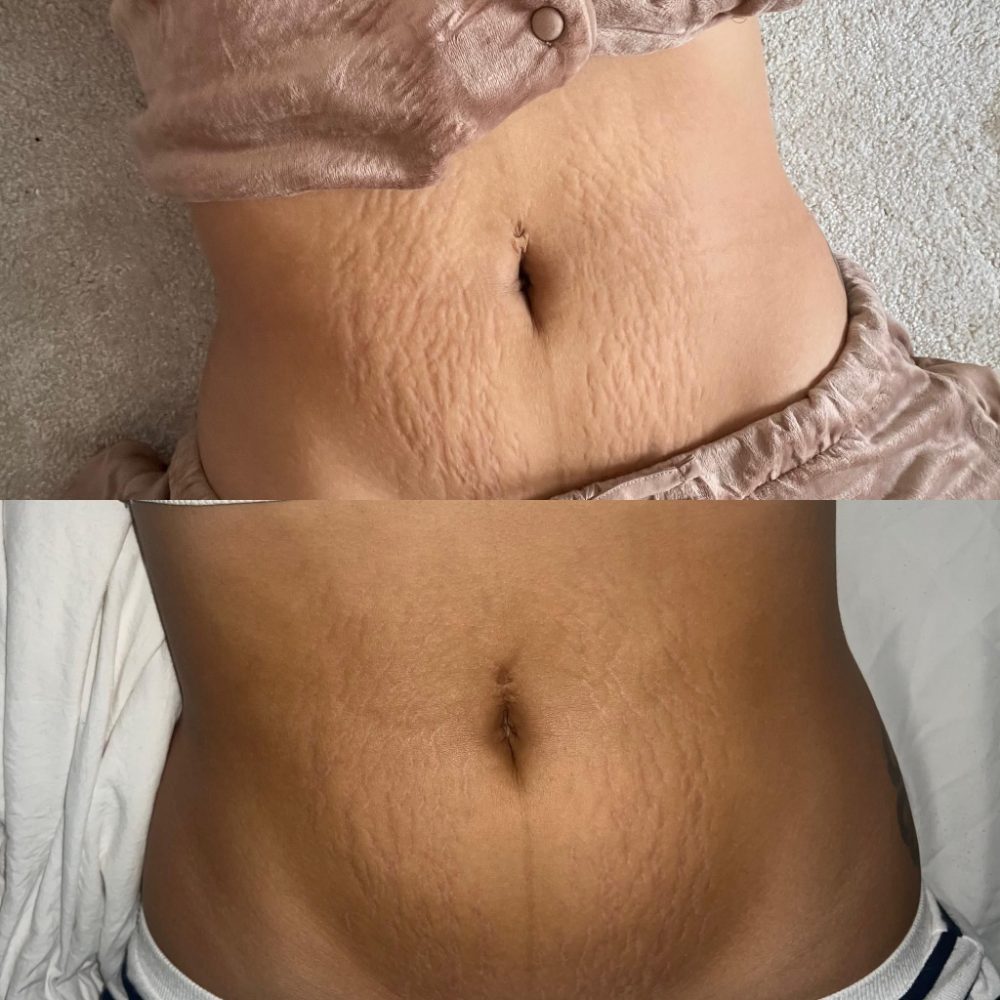 Striā Lab Programme before and after, stomach