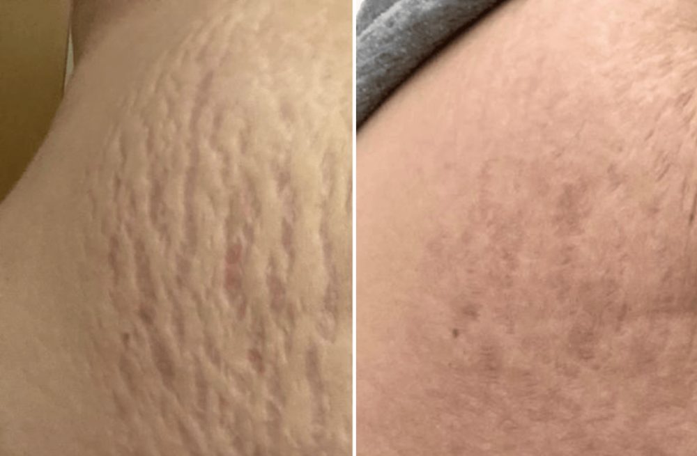 Striā Lab Programme before and after, thigh