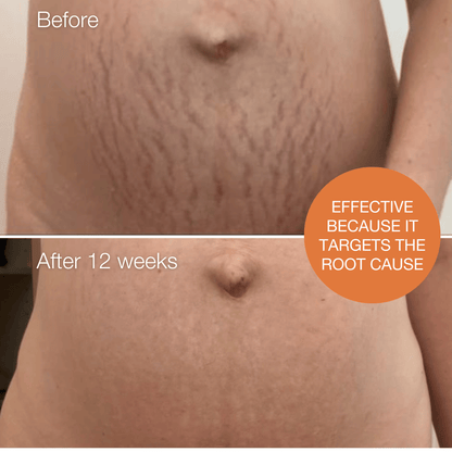 Redefining Stretch Mark Cream