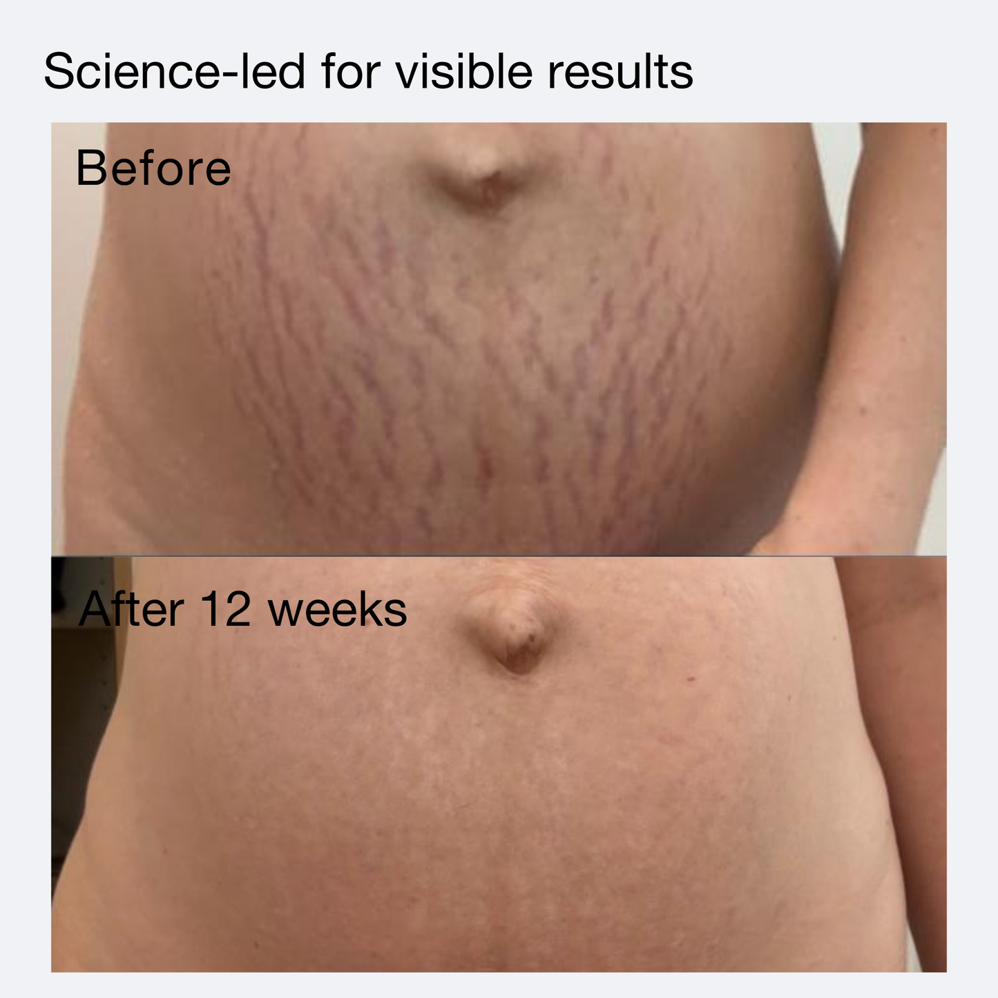 Stretch Mark Repair Starter Kit