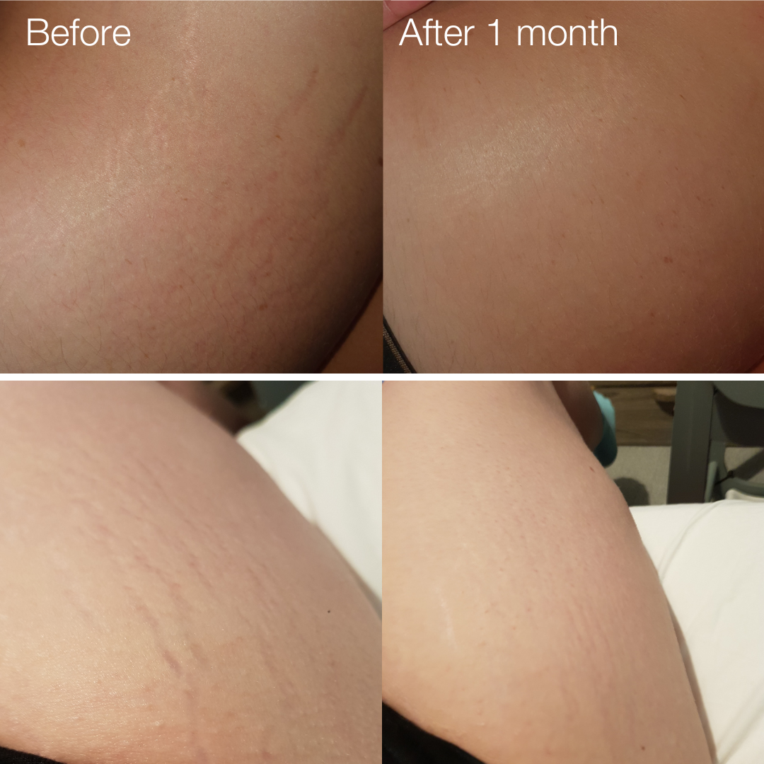 Stretch Mark Microneedling Tool