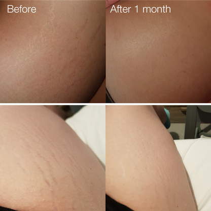Stretch Mark Microneedling Tool