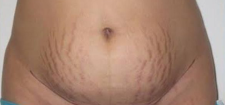 Customer photo before using the Striā Lab programme
