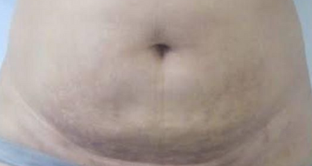 The same customer after using the Striā Lab programme