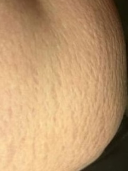 Customer photo before using the Striā Lab programme