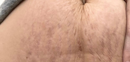 The same customer after using the Striā Lab programme