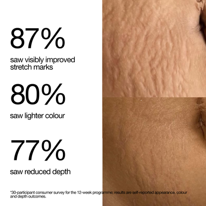 Stretch Mark Programme