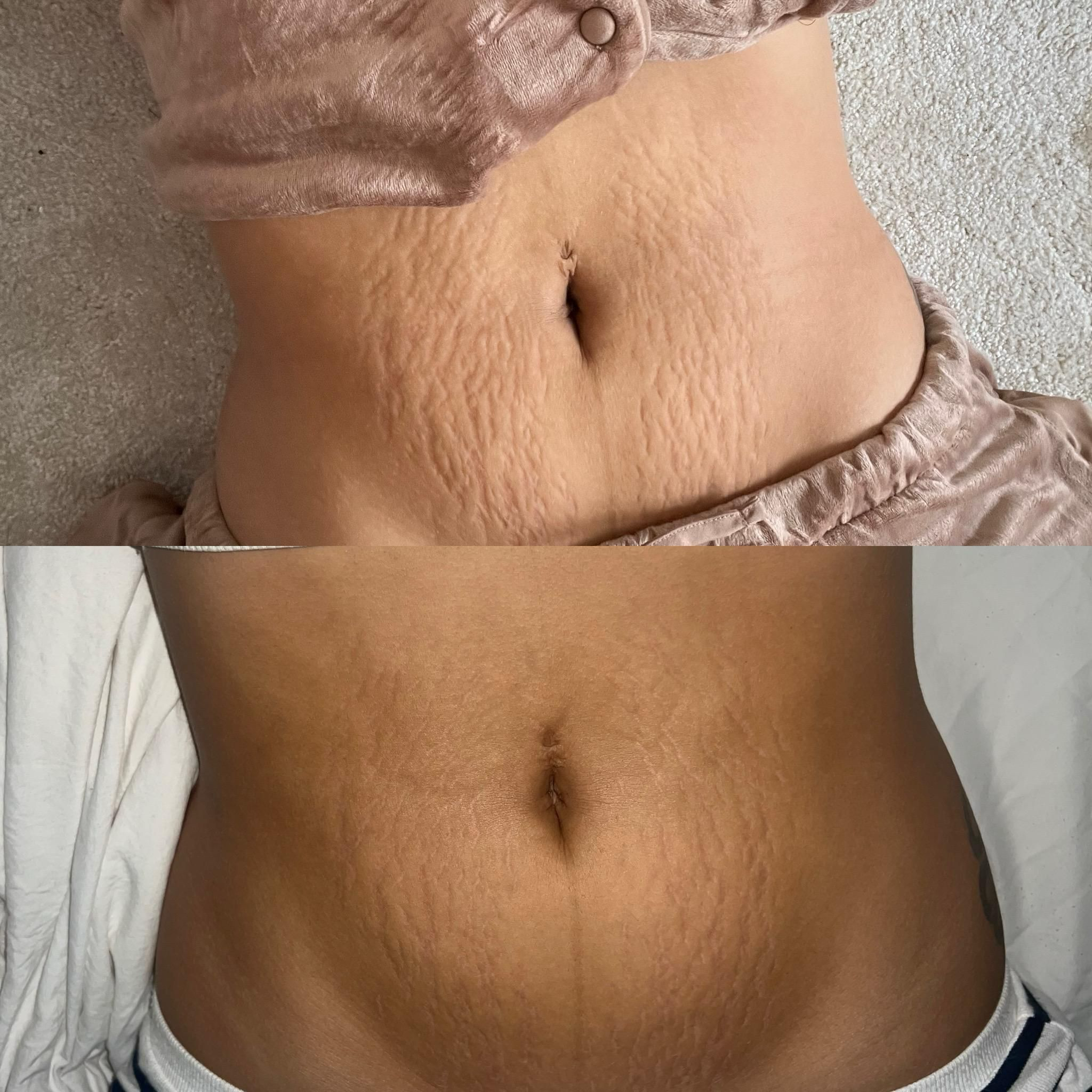 Stria Lab before and after result
