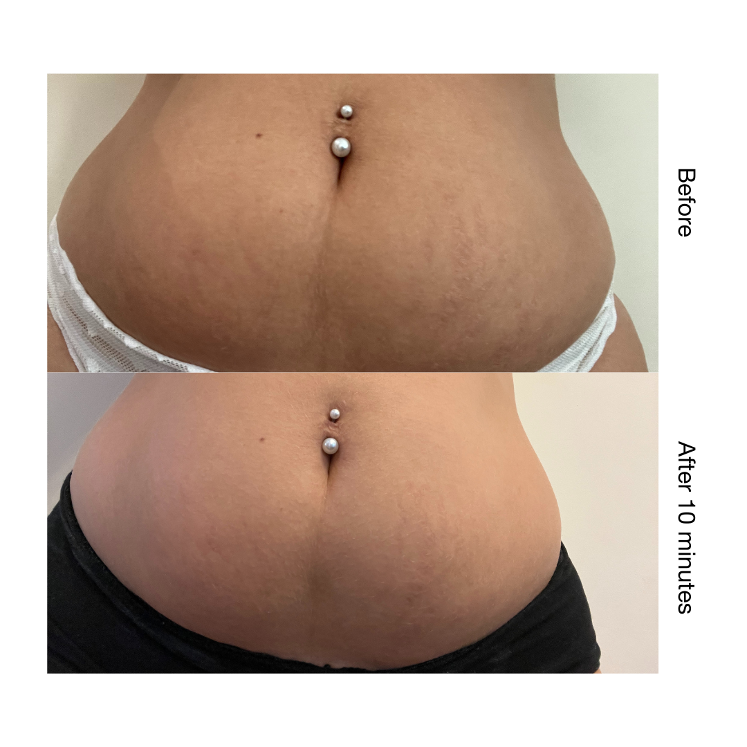 Stria Lab before and after result