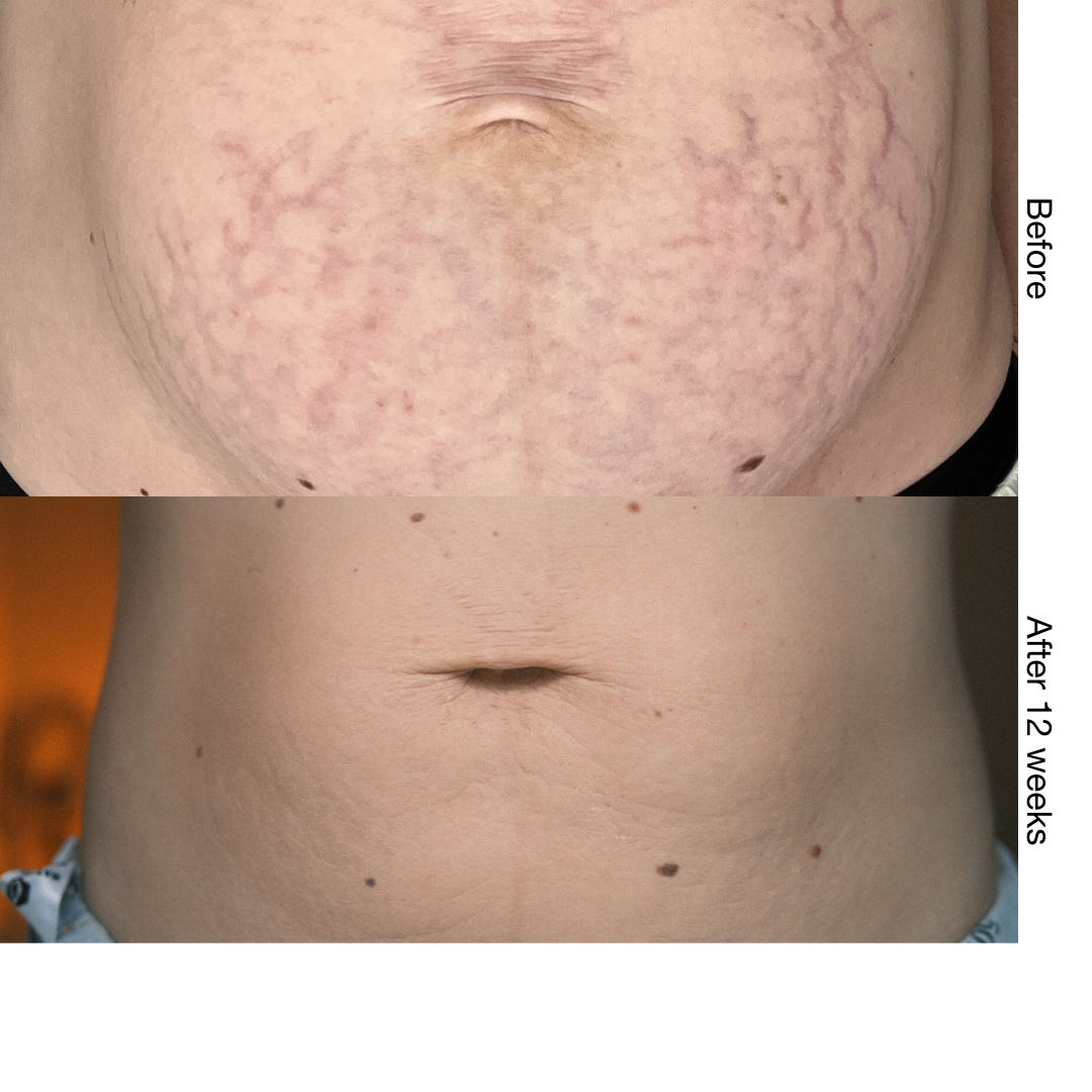 Stria Lab before and after result