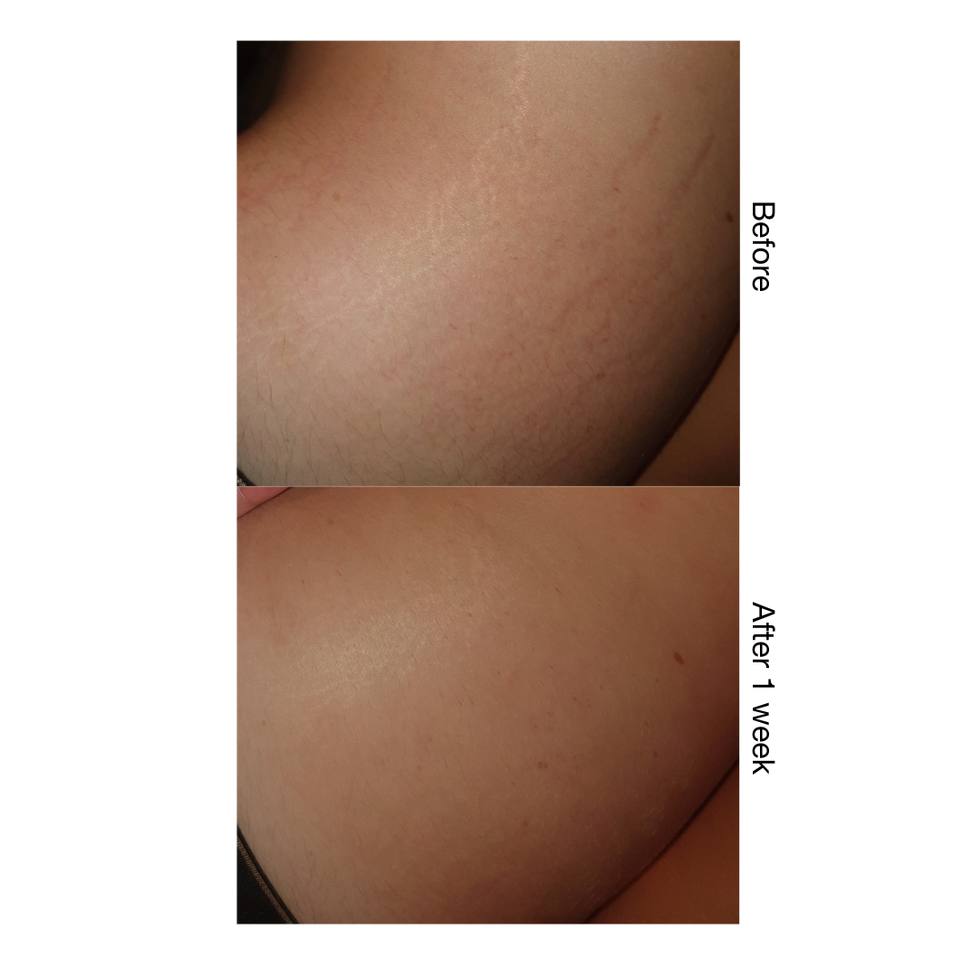 Stria Lab before and after result