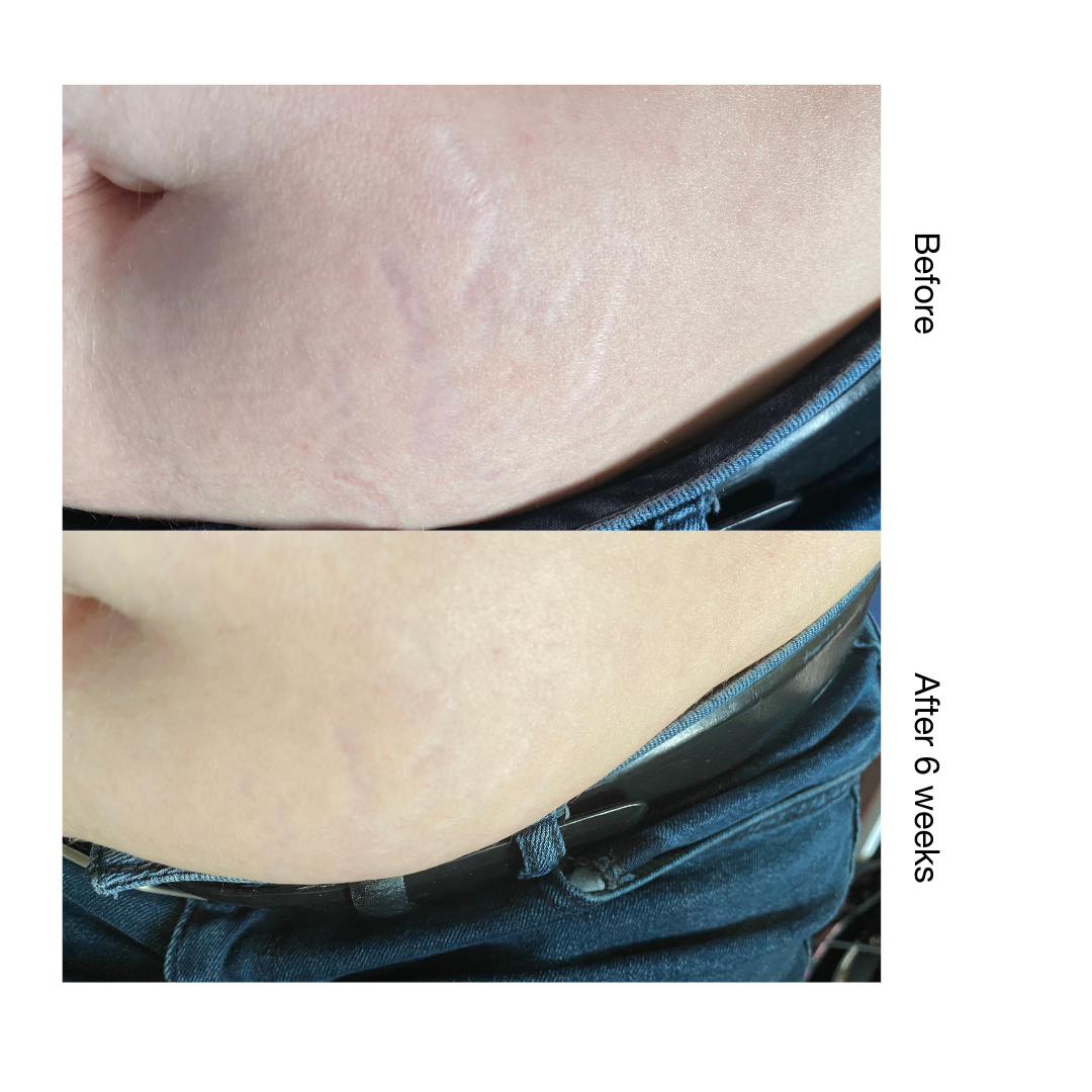 Stria Lab before and after result