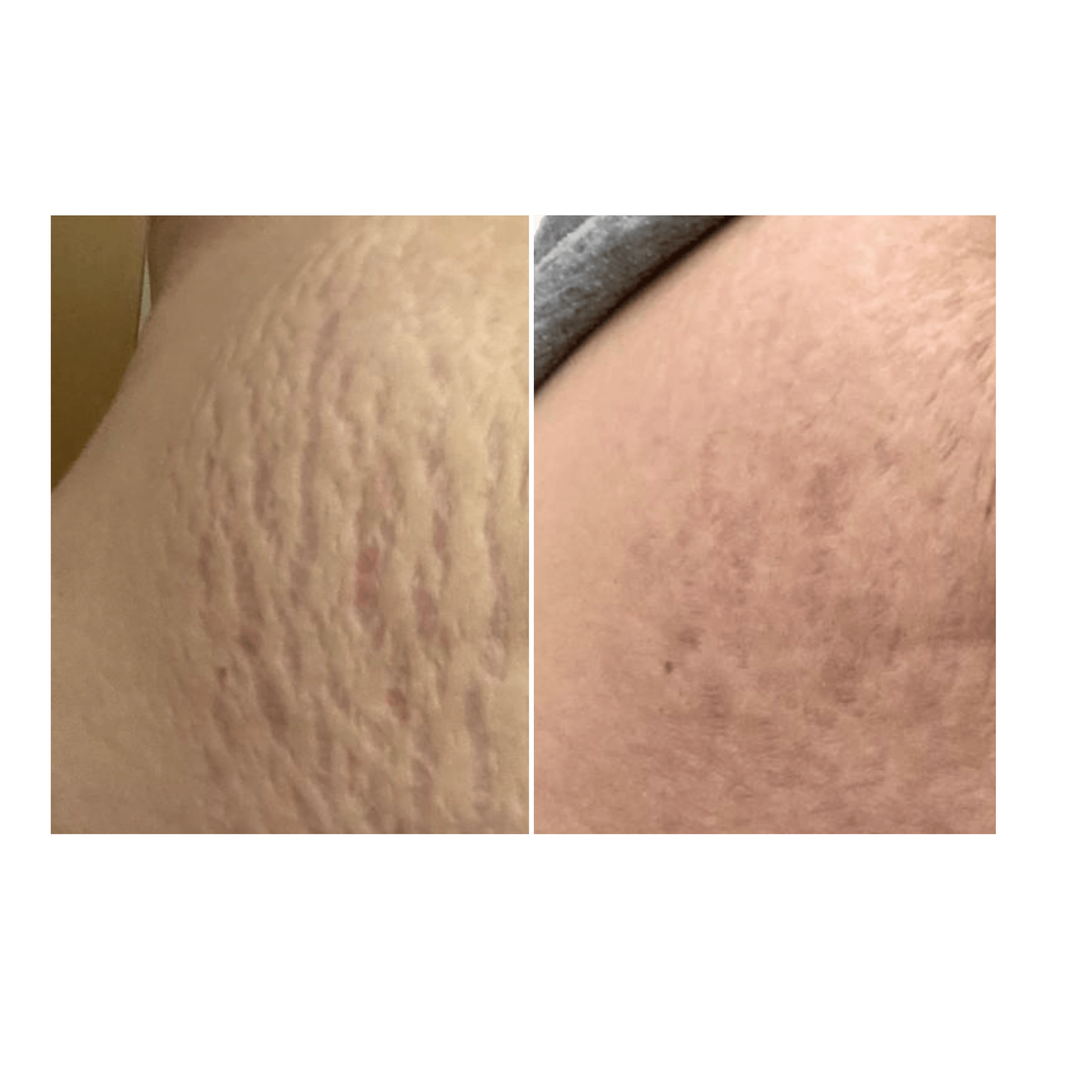 Stria Lab before and after result