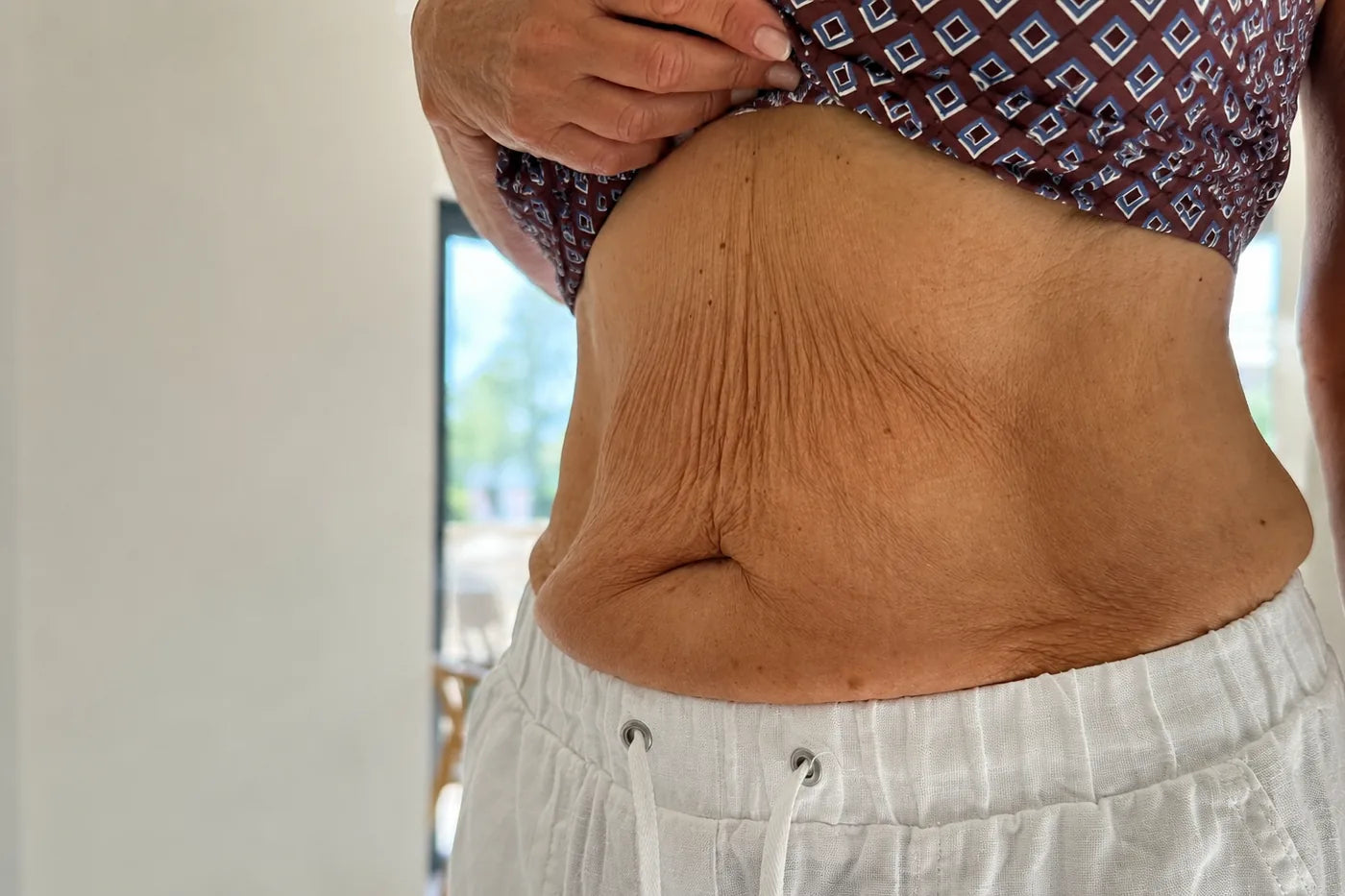 Close view of a woman's midriff, her top lifted, showing fine crinkled skin across the side of the abdomen