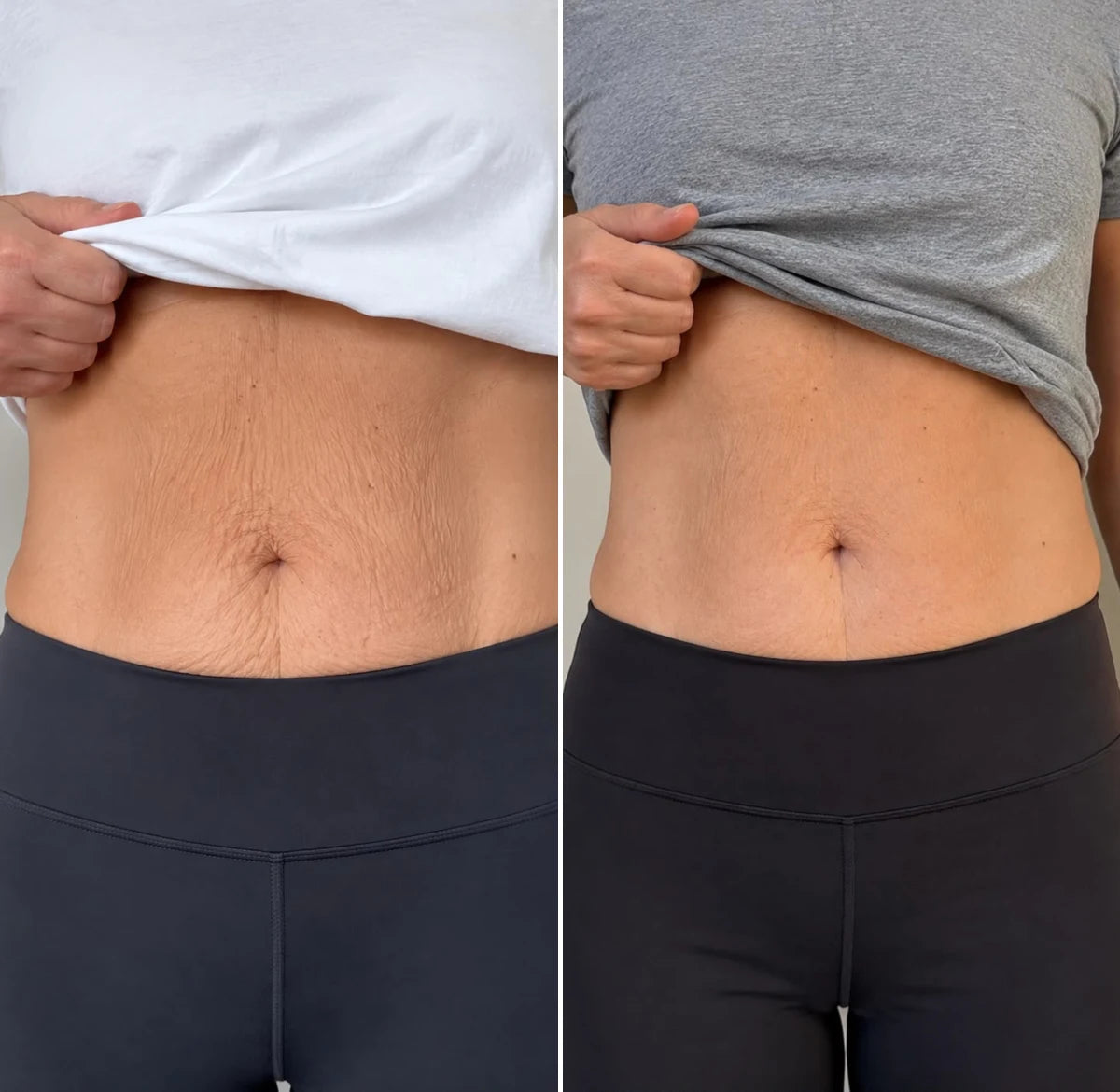 Close-up of crepey skin after weight loss