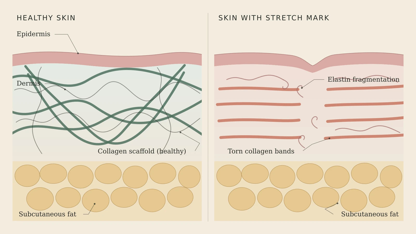 Editorial cross-section diagram comparing healthy skin with intact collagen scaffold against skin with a stretch mark showing torn collagen bands and elastin fragmentation in the dermal layer.