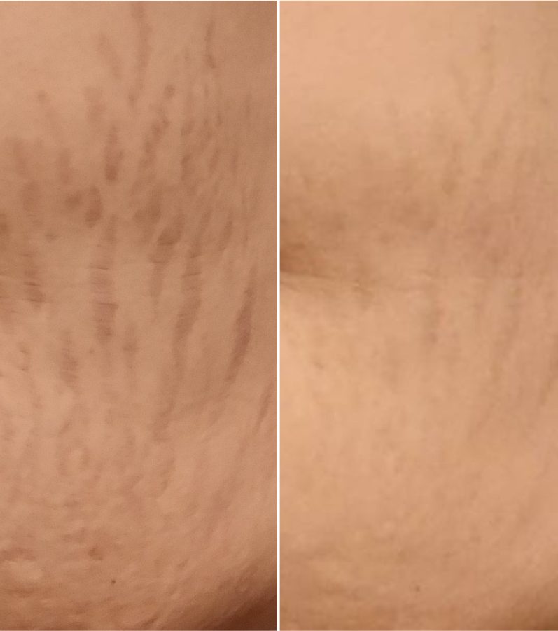 Striā Lab Programme before and after, hip